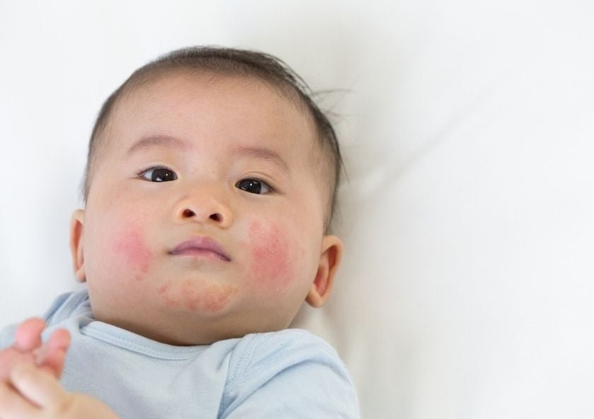 الأكزيما عند الأطفال والرضع (التهاب الجلد التأتبي)