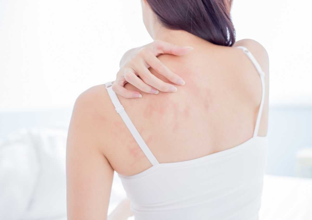 Is eczema contagious? Here are the causes of eczema…