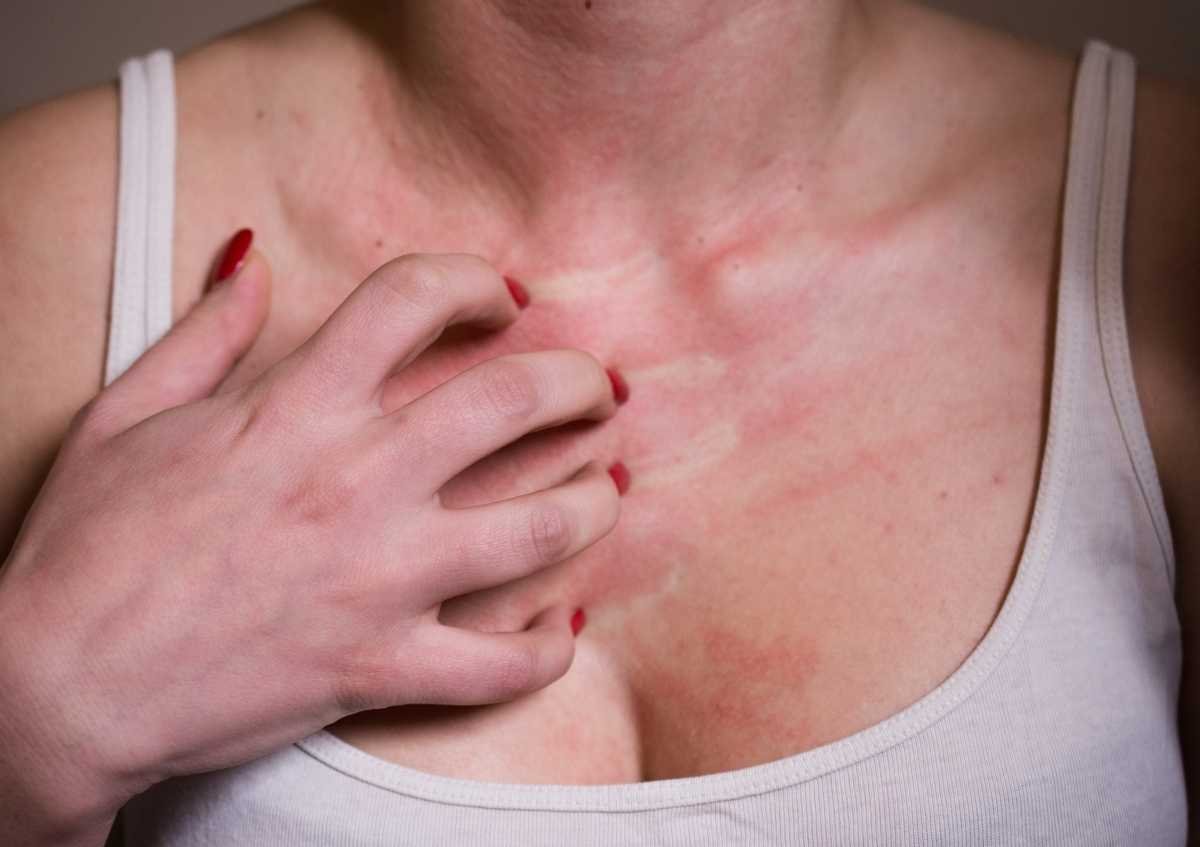 What Is Sun Allergy? Sun Allergy Symptoms and Treatment