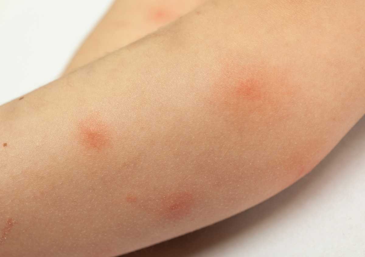 What is mosquito bite allergy? What is good for mosquito bite?