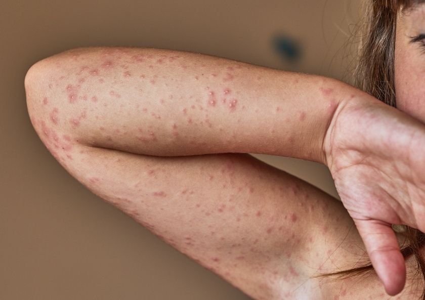 Hives (Urticaria) - Symptoms and Causes