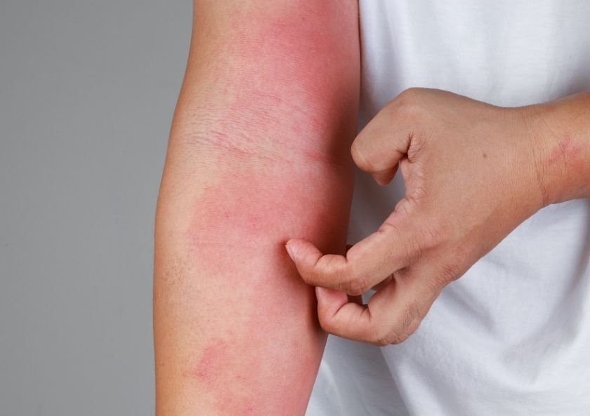 What Are the Symptoms of Allergic Contact Dermatitis?